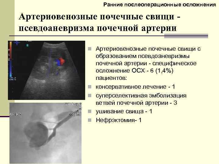 Ранние послеоперационные осложнения Артериовенозные почечные свищи псевдоаневризма почечной артерии n Артериовенозные почечные свищи с