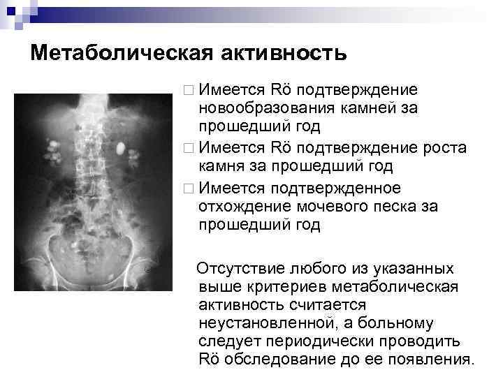 Метаболическая активность ¨ Имеется Rö подтверждение новообразования камней за прошедший год ¨ Имеется Rö