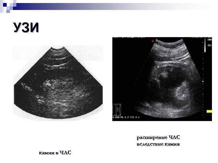 УЗИ расширение ЧЛС вследствие камня камни в ЧЛС 
