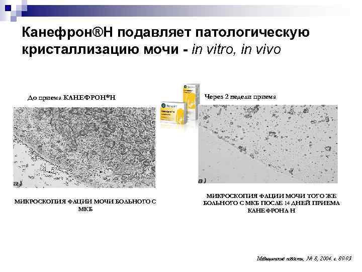 Канефрон®Н подавляет патологическую кристаллизацию мочи - in vitro, in vivo До приема КАНЕФРОН®Н МИКРОСКОПИЯ