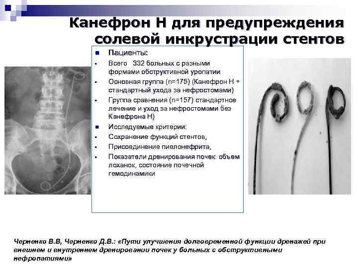 Канефрон Н для предупреждения солевой инкрустрации стентов n Пациенты: • Всего 332 больных с