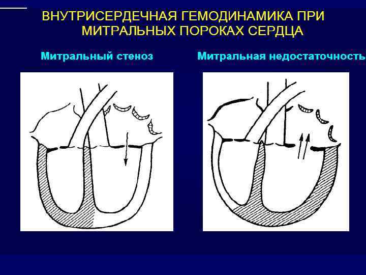 Гемодинамика при митральном стенозе