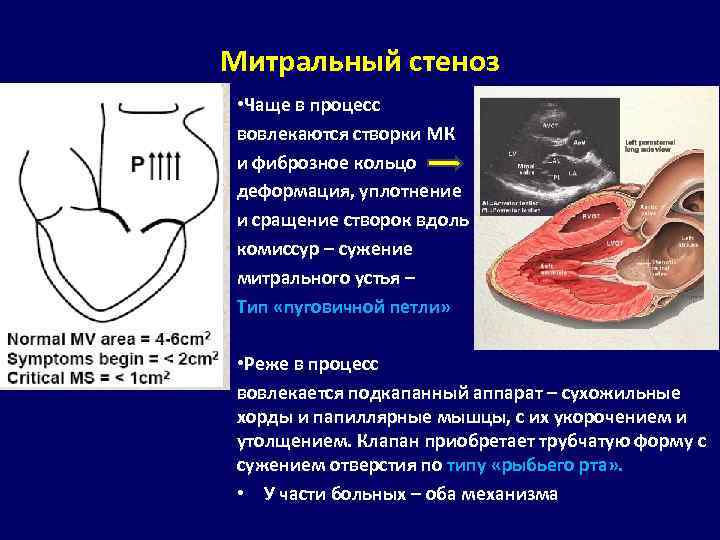 Фиброзное кольцо митрального клапана