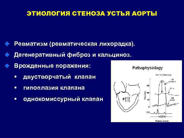 Степени кальциноза аортального клапана. Аортальный стеноз этиология.