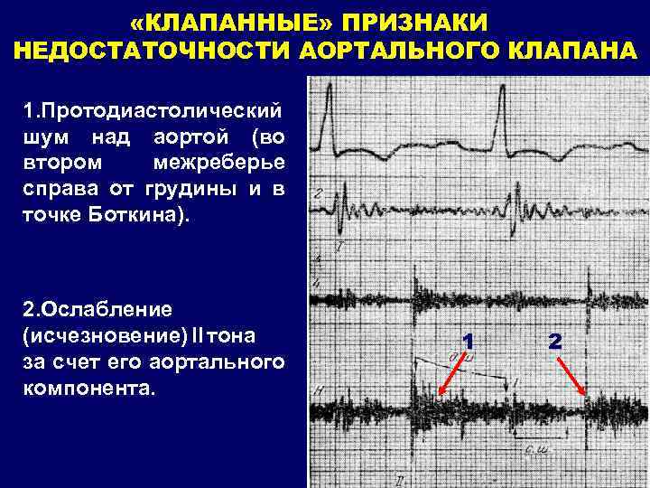 Причины недостаточности аортального клапана