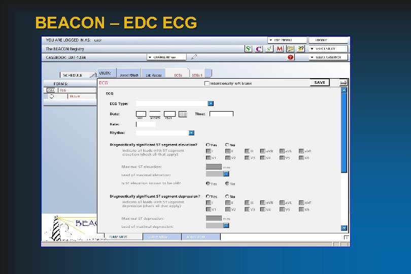 BEACON – EDC ECG 