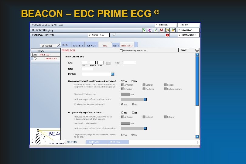 BEACON – EDC PRIME ECG ® 