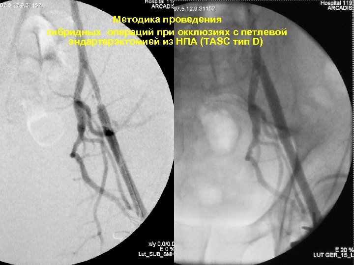 Методика проведения гибридных операций при окклюзиях с петлевой эндартерэктомией из НПА (TASC тип D)