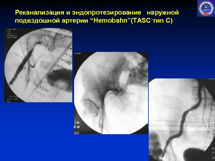 Реканализация и эндопротезирование наружной подвздошной артерии “Hemobahn”(TASC тип С) 