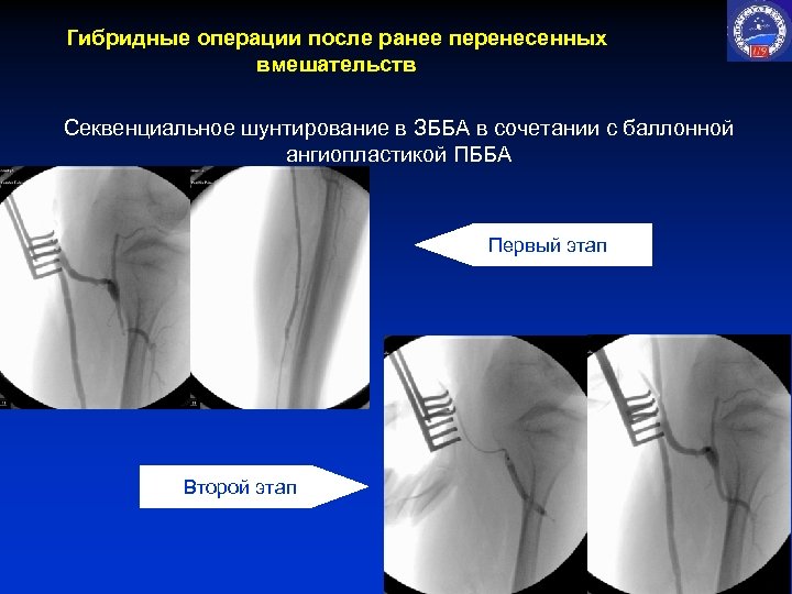 Гибридные операции после ранее перенесенных вмешательств Секвенциальное шунтирование в ЗББА в сочетании с баллонной