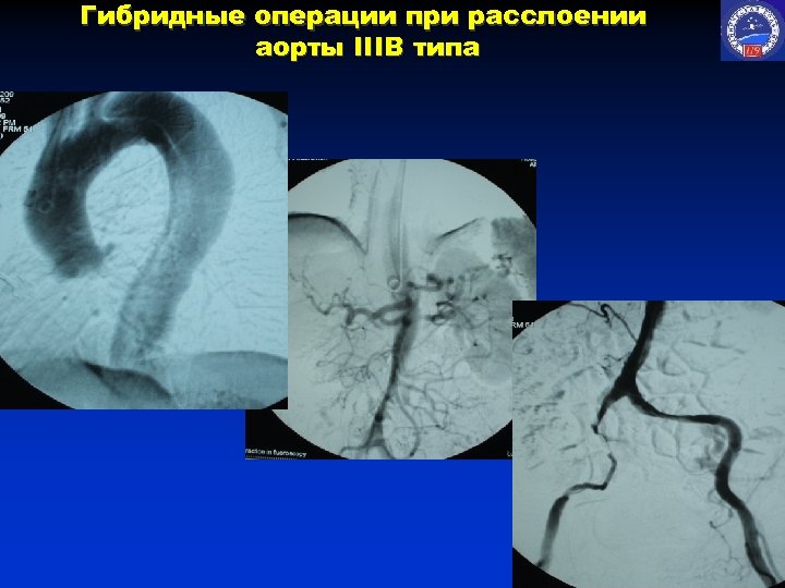 Гибридные операции при расслоении аорты IIIB типа 