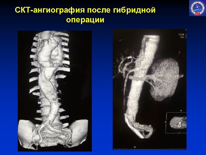 СКТ-ангиография после гибридной операции 