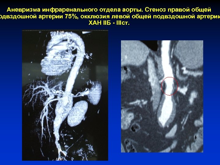 Аневризма инфраренального отдела аорты. Стеноз правой общей одвздошной артерии 75%, окклюзия левой общей подвздошной