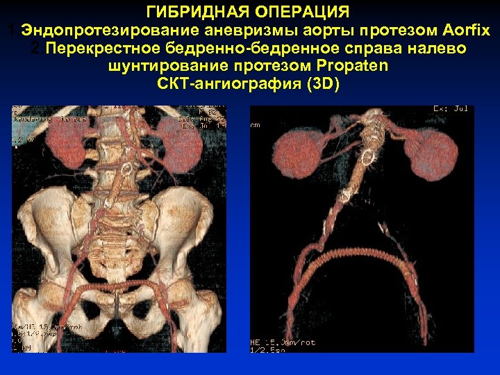 ГИБРИДНАЯ ОПЕРАЦИЯ 1. Эндопротезирование аневризмы аорты протезом Aorfix 2. Перекрестное бедренно-бедренное справа налево шунтирование