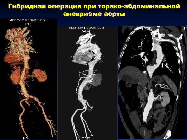 Гибридная операция при торако-абдоминальной аневризме аорты 