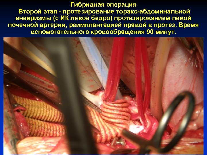 Гибридная операция Второй этап - протезирование торако-абдоминальной аневризмы (с ИК левое бедро) протезированием левой