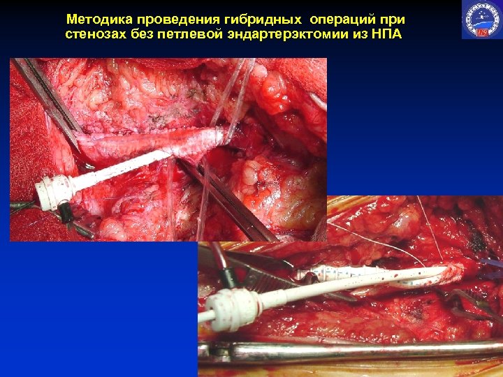 Методика проведения гибридных операций при стенозах без петлевой эндартерэктомии из НПА 