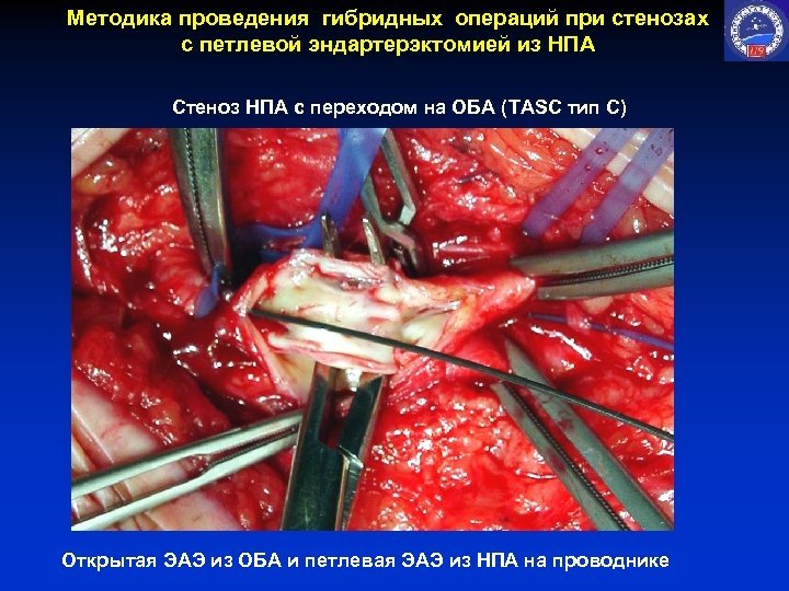 Методика проведения гибридных операций при стенозах с петлевой эндартерэктомией из НПА Стеноз НПА с