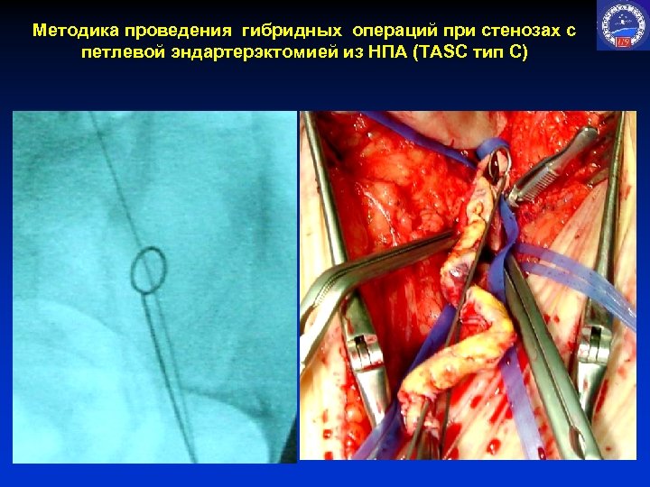 Методика проведения гибридных операций при стенозах с петлевой эндартерэктомией из НПА (TASC тип С)