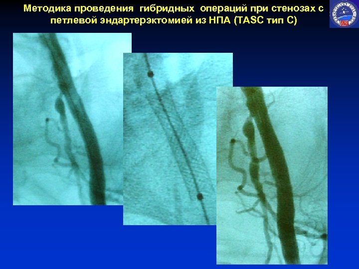 Методика проведения гибридных операций при стенозах с петлевой эндартерэктомией из НПА (TASC тип С)