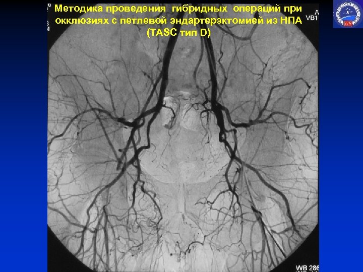 Методика проведения гибридных операций при окклюзиях с петлевой эндартерэктомией из НПА (TASC тип D)