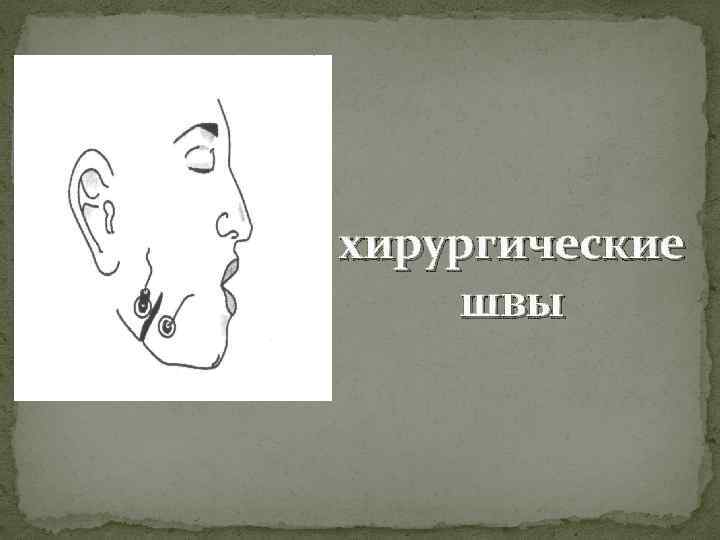 хирургические швы 