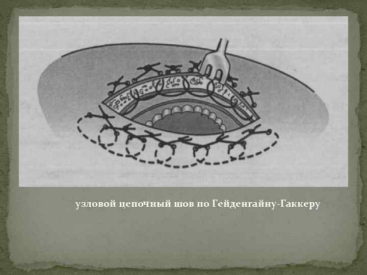 узловой цепочный шов по Гейденгайну-Гаккеру 