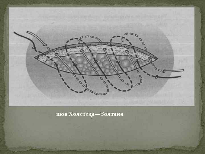 шов Холстеда—Золтана 