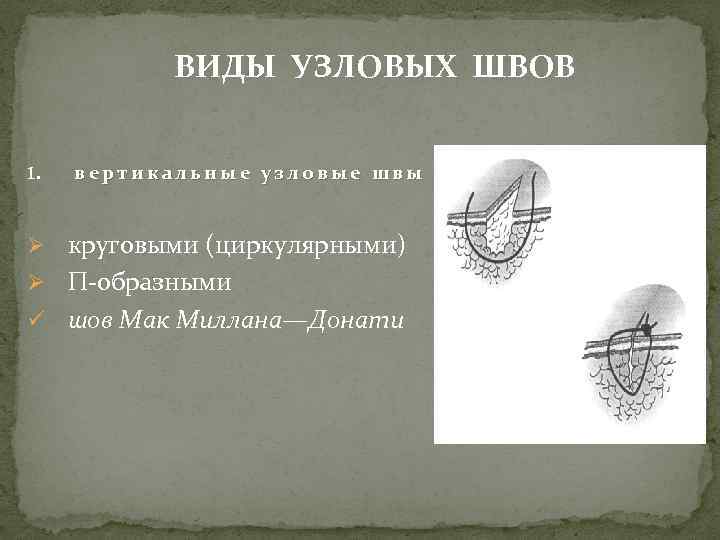 ВИДЫ УЗЛОВЫХ ШВОВ 1. вертикальные узловые швы Ø круговыми (циркулярными) Ø П-образными ü шов
