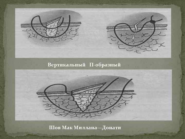 Х образный шов. Шов Мак-Миллана –Донати. Горизонтальный и вертикальный шов по Донати. Вертикальный матрацный шов Донати. Узловой п образный шов.