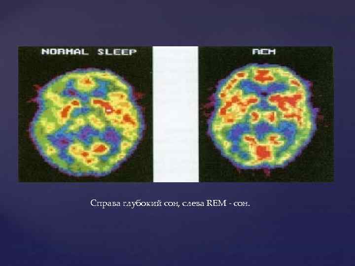 Справа глубокий сон, слева REM - сон. 