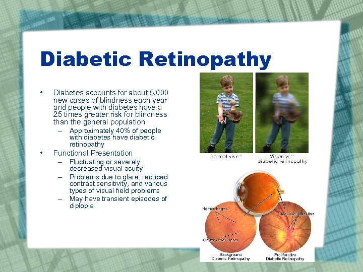 Diabetic Retinopathy • Diabetes accounts for about 5, 000 new cases of blindness each