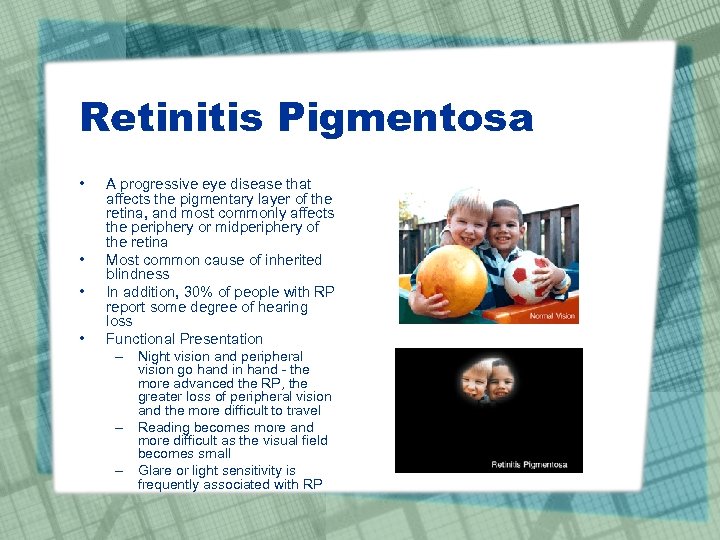 Retinitis Pigmentosa • • A progressive eye disease that affects the pigmentary layer of