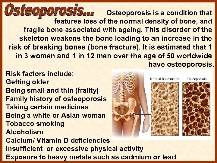 Osteoporosis is a condition that features loss of the normal density of bone, and