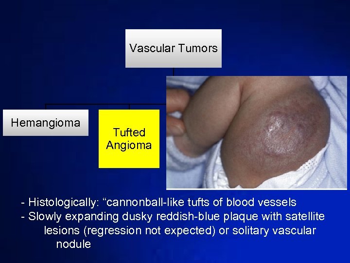 Vascular Tumors Hemangioma Tufted Angioma Kaposiform hemangioend othelioma Diffuse Hemangioma - Histologically: “cannonball-like tufts