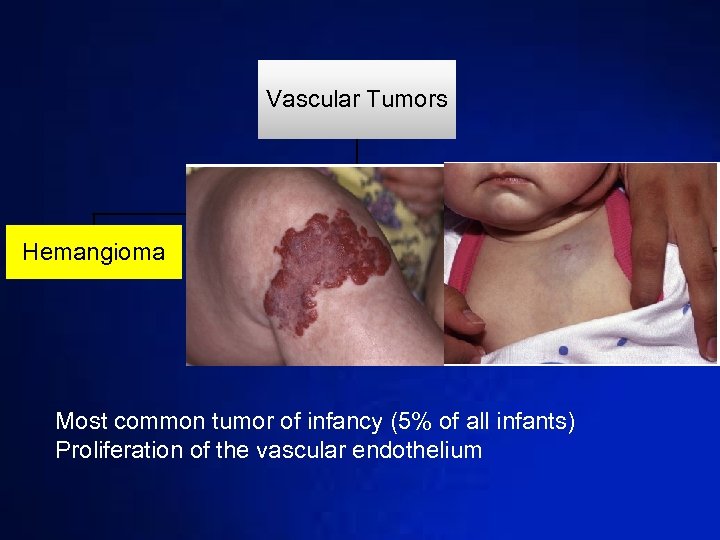 Vascular Tumors Hemangioma Tufted Angioma Kaposiform hemangioend othelioma Diffuse Hemangioma Most common tumor of