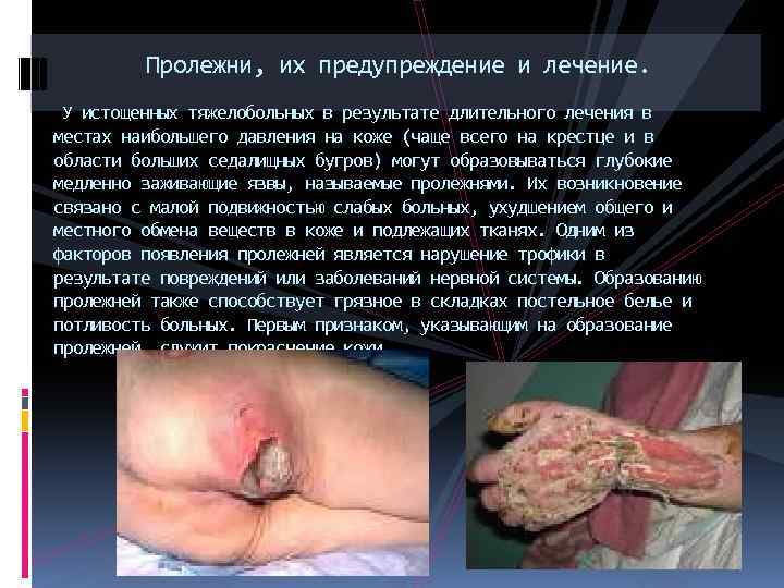 Пролежни, их предупреждение и лечение. У истощенных тяжелобольных в результате длительного лечения в местах