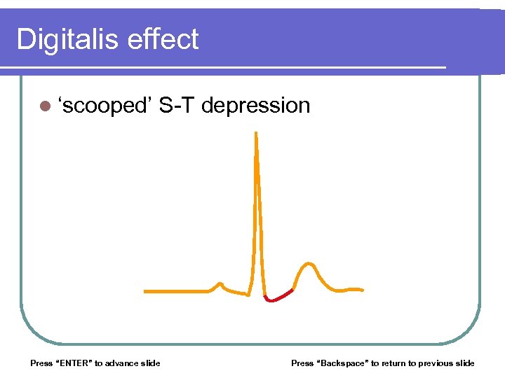 Digitalis effect l ‘scooped’ S-T depression Press “ENTER” to advance slide Press “Backspace” to