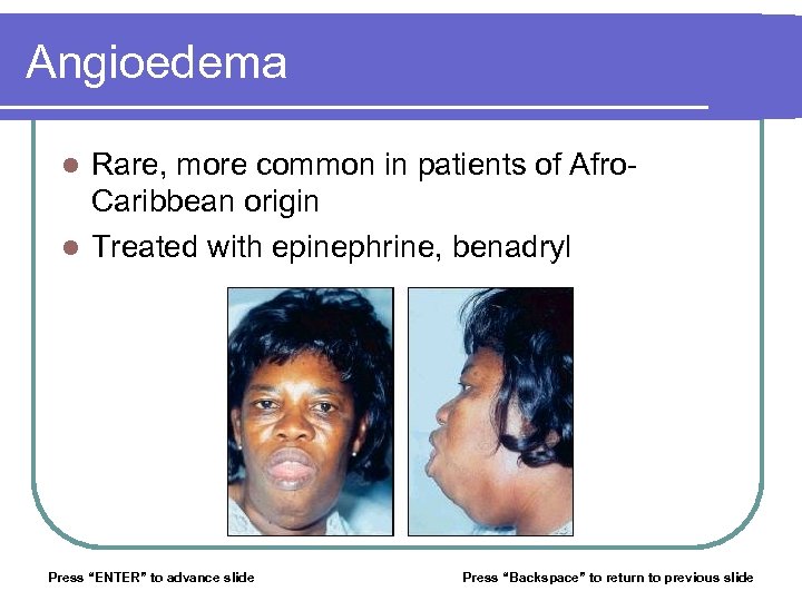 Angioedema Rare, more common in patients of Afro. Caribbean origin l Treated with epinephrine,