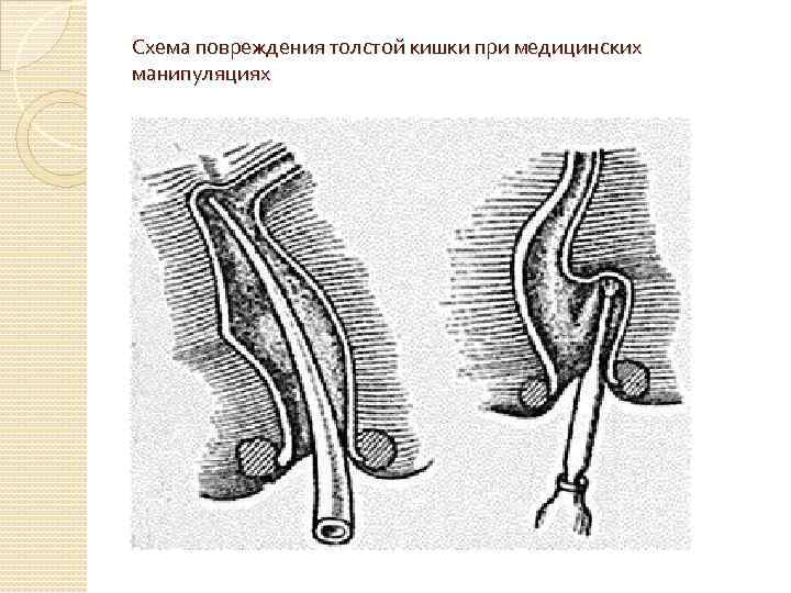 Схема повреждения толстой кишки при медицинских манипуляциях 