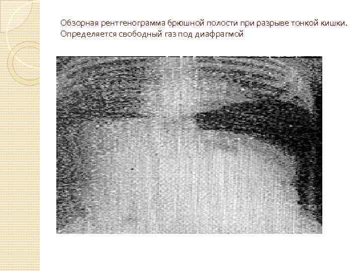 Обзорная рентгенограмма брюшной полости при разрыве тонкой кишки. Определяется свободный газ под диафрагмой 