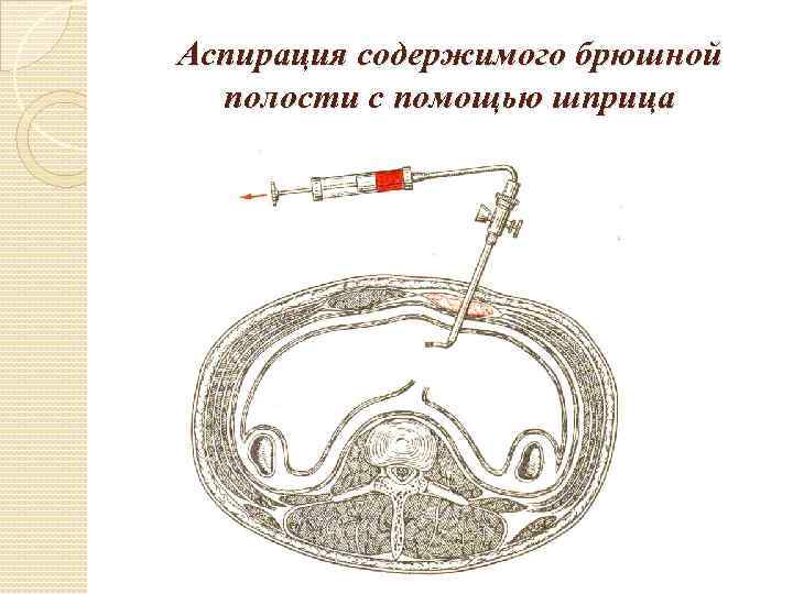 Аспирация содержимого брюшной полости с помощью шприца 