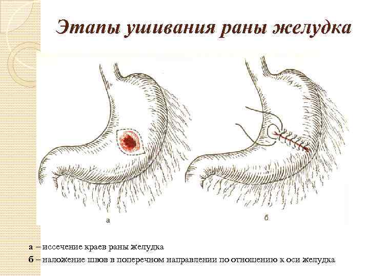 Этапы ушивания раны желудка а – иссечение краев раны желудка б – наложение швов