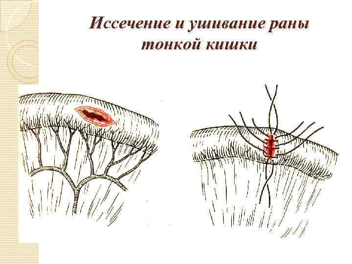 Иссечение и ушивание раны тонкой кишки 