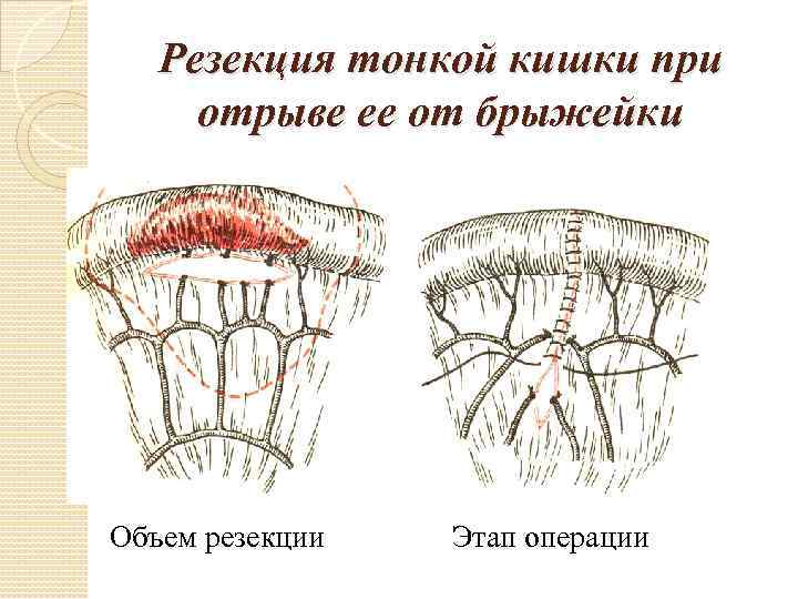 Резекция тонкой кишки при отрыве ее от брыжейки Объем резекции Этап операции 