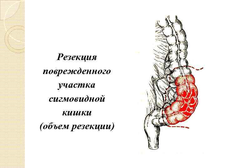 Резекция поврежденного участка сигмовидной кишки (объем резекции) 