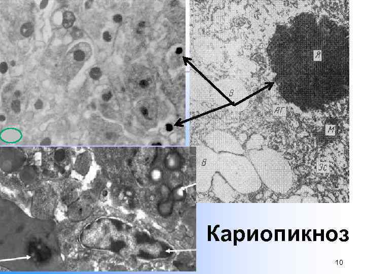 Кариопикноз 10 