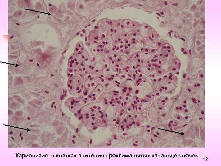 Кариолизис в клетках эпителия проксимальных канальцев почек. 12 