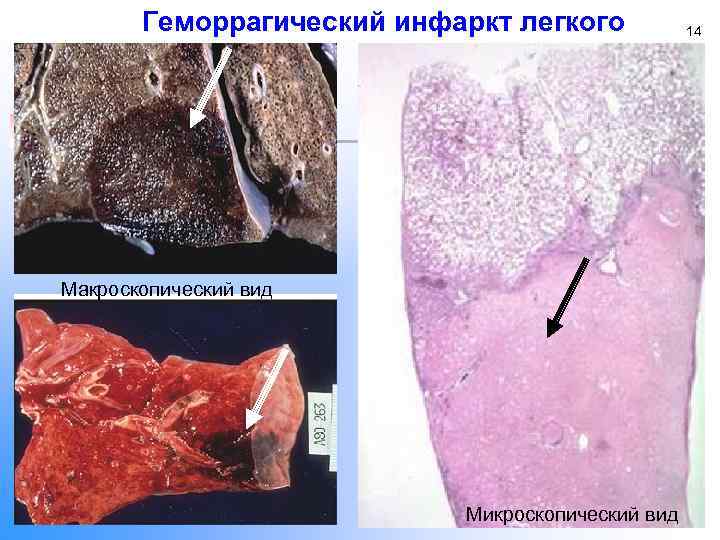 Геморрагический инфаркт легкого Макроскопический вид Микроскопический вид 14 