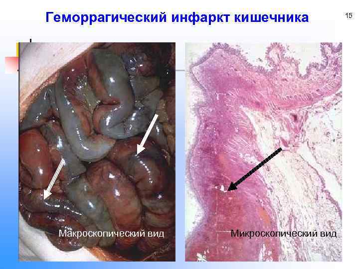 Геморрагический инфаркт кишечника Макроскопический вид Микроскопический вид 15 